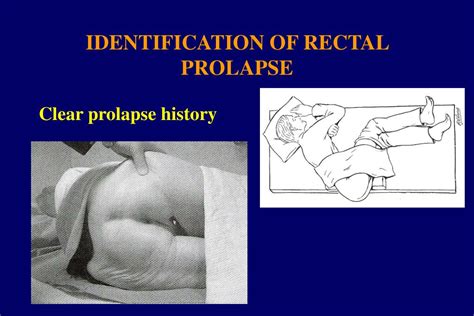 Rectal prolapse